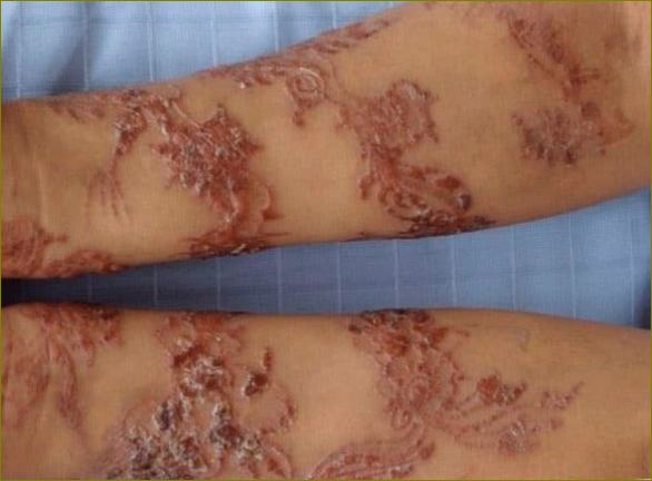 Алергия към татуировка с къна